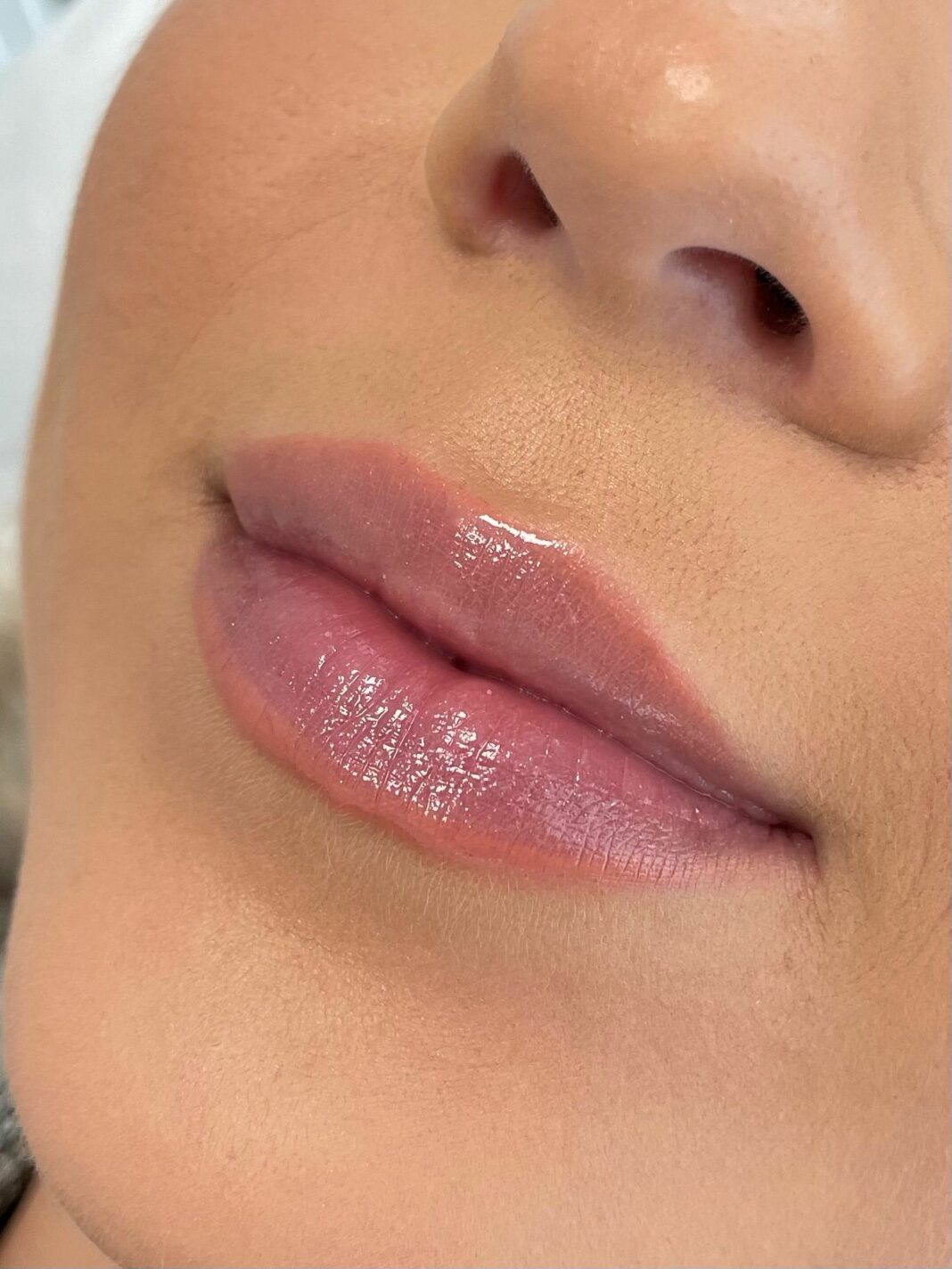Why You Should Always Choose a Certified Professional for Lip Fillers