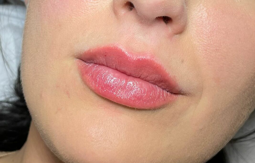 Exploring the Different Lip Filler Techniques for Perfect Lips