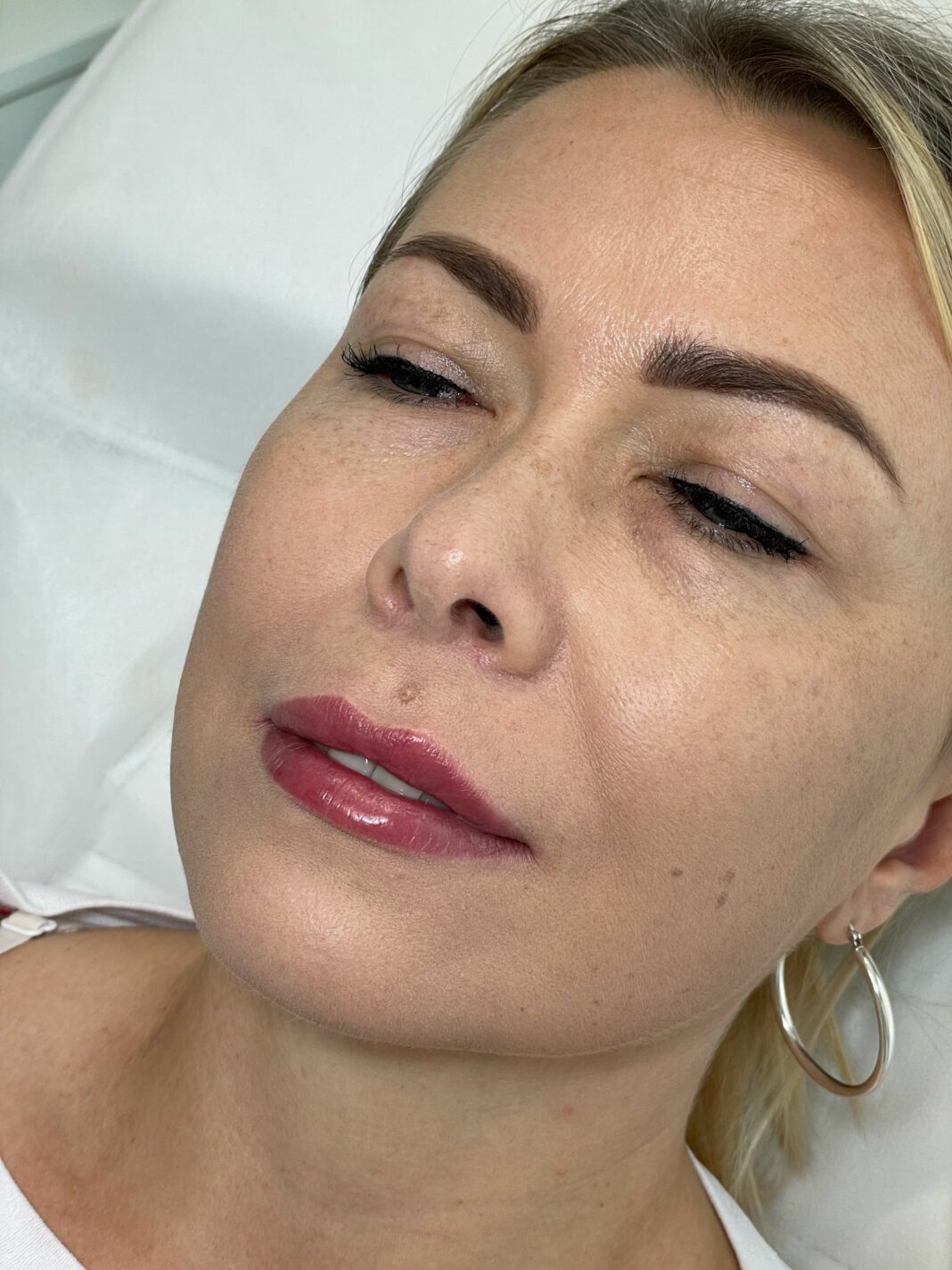 Why Lip Fillers Are the Go-To Treatment for a Fuller Pout