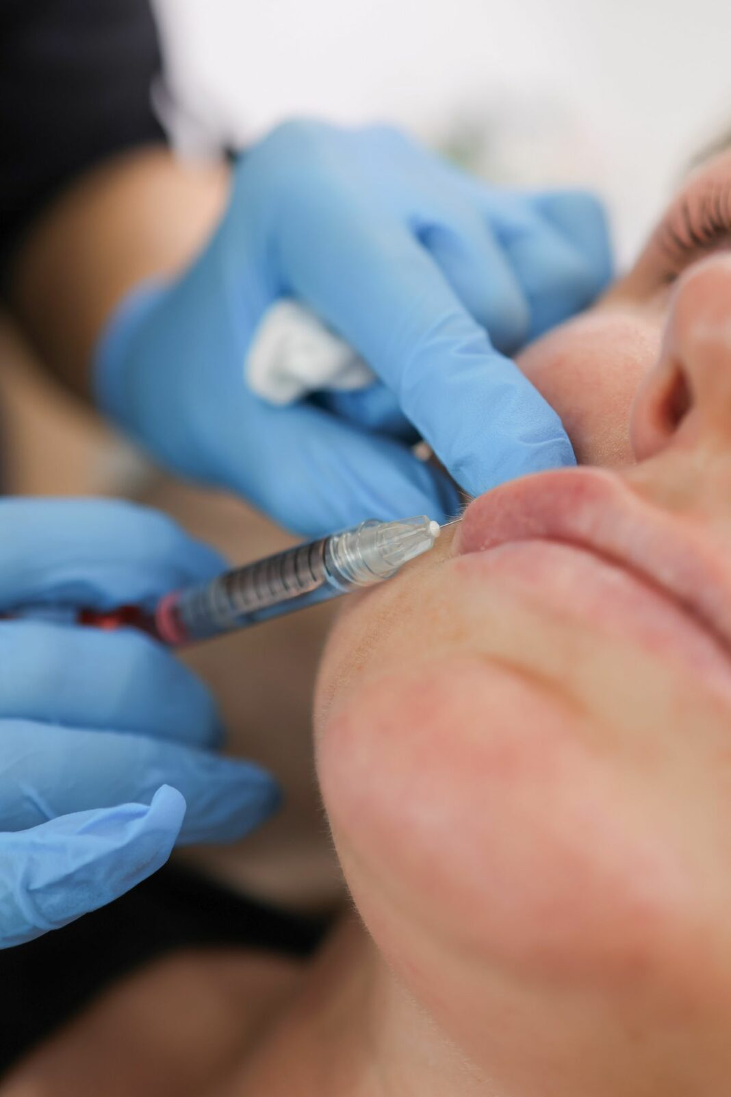 Lip Filler Recovery: What to Expect After Your Appointment