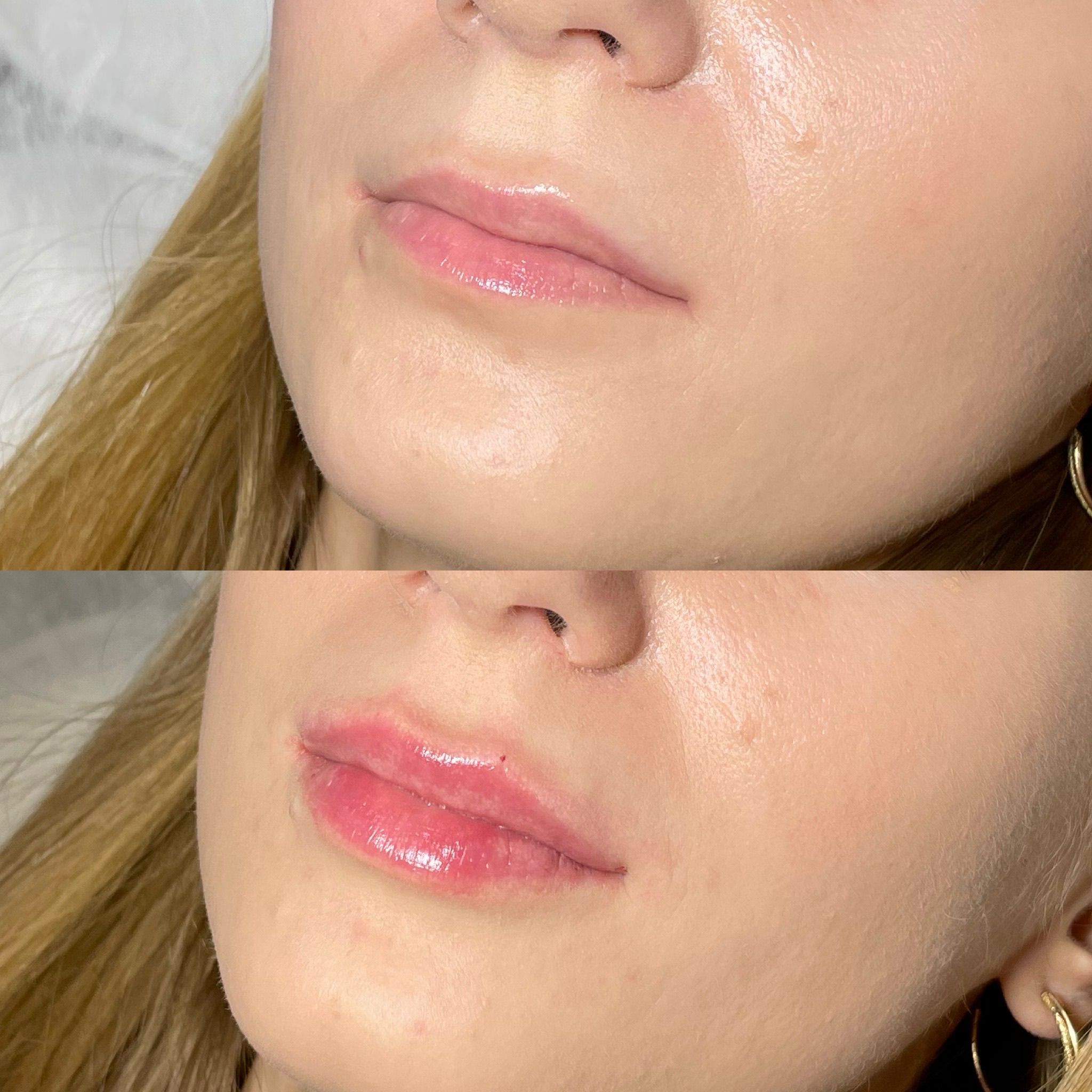 Lip Filler London - Natural Lip Enhancement & Lip Augmentation