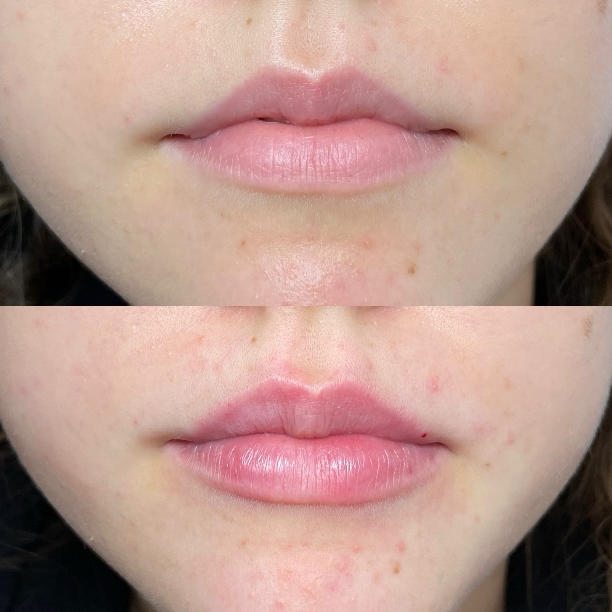 Lip Filler London - Natural Lip Enhancement & Lip Augmentation
