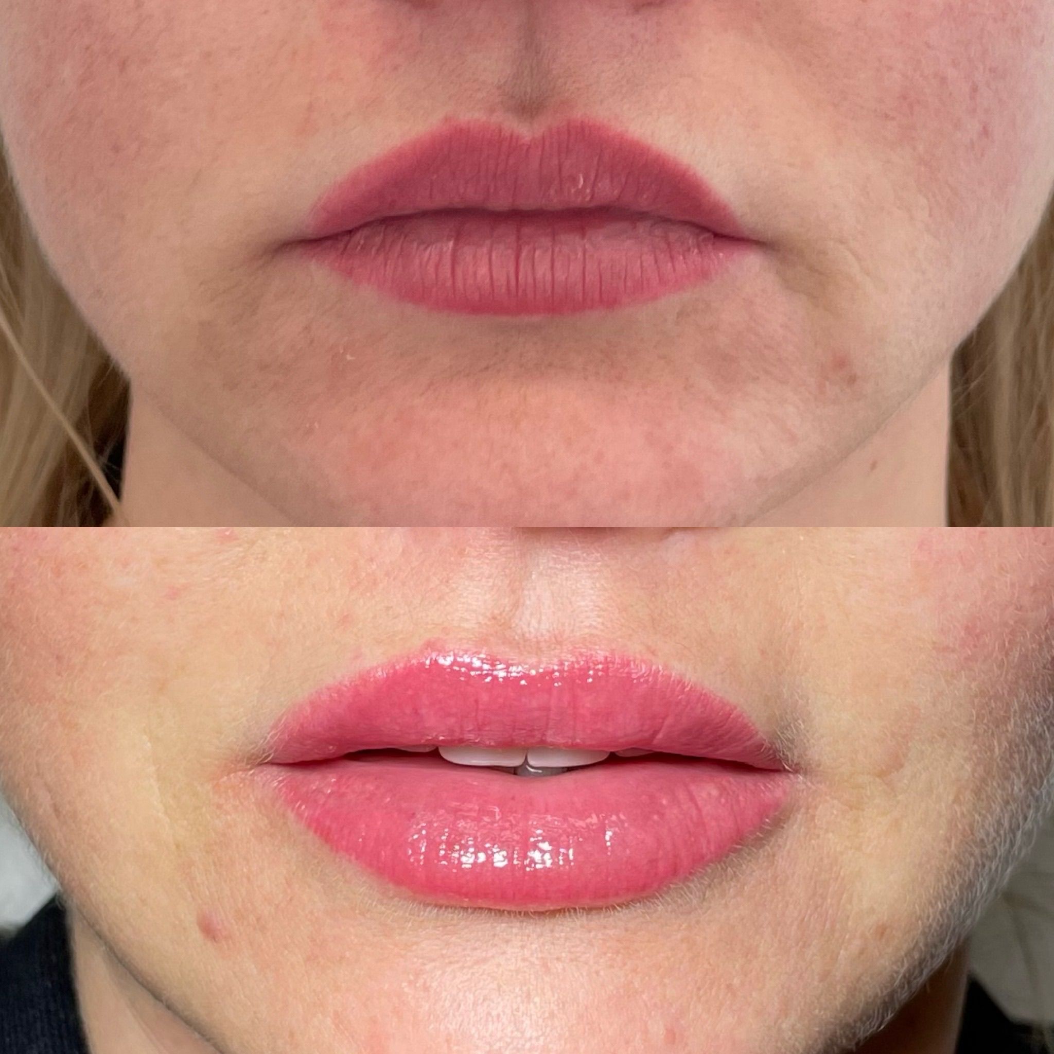 Lip Filler London - Natural Lip Enhancement & Lip Augmentation