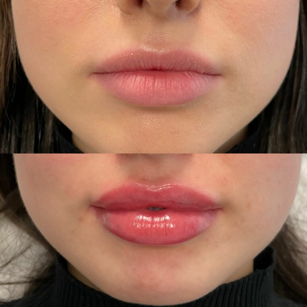 Lip Filler London - Natural Lip Enhancement & Lip Augmentation